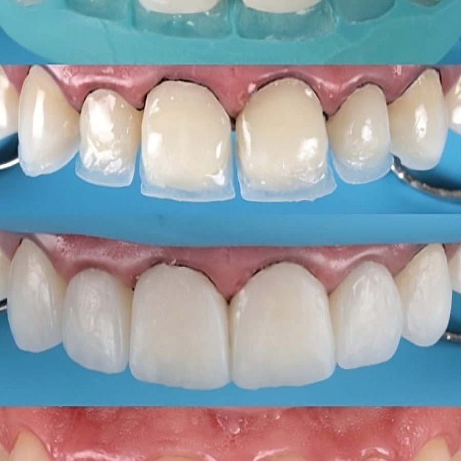 resina_estetica-transformed